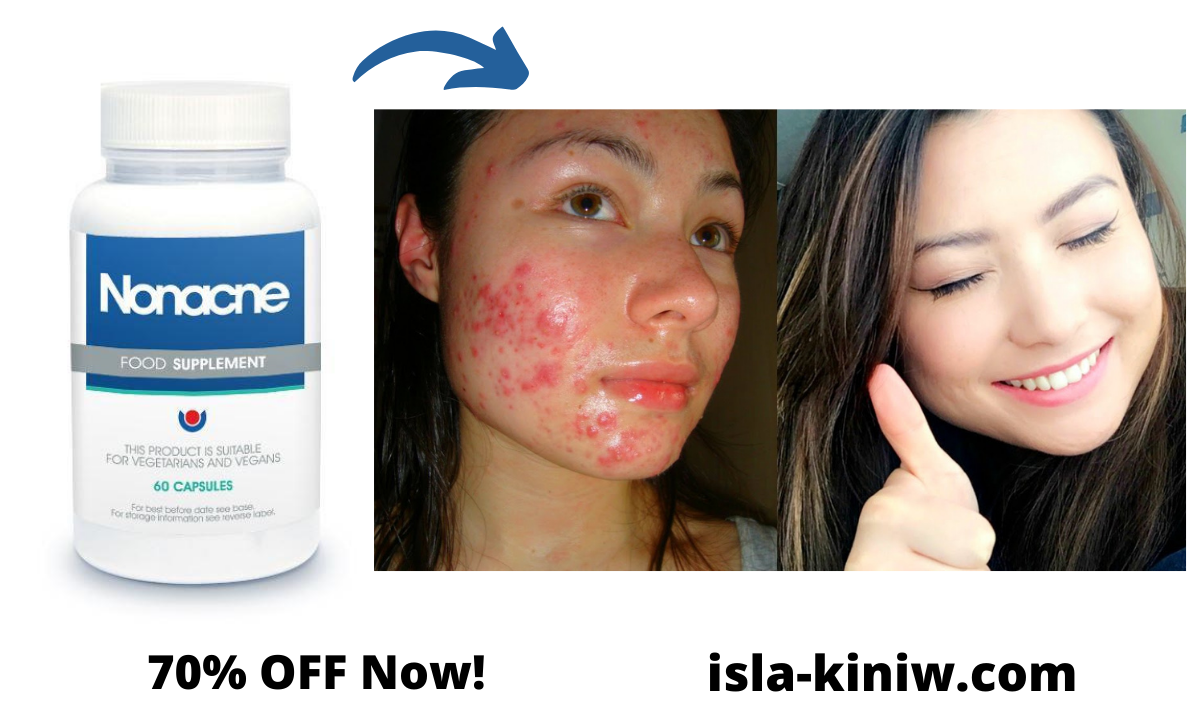 Nonacne Review (Updated) : does Nonacne Acne Supplement work for