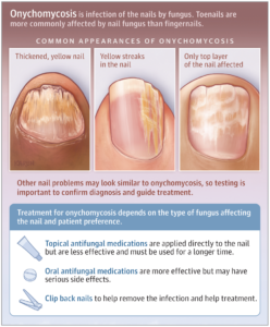 Overcoming Onychomycosis Nail Fungus