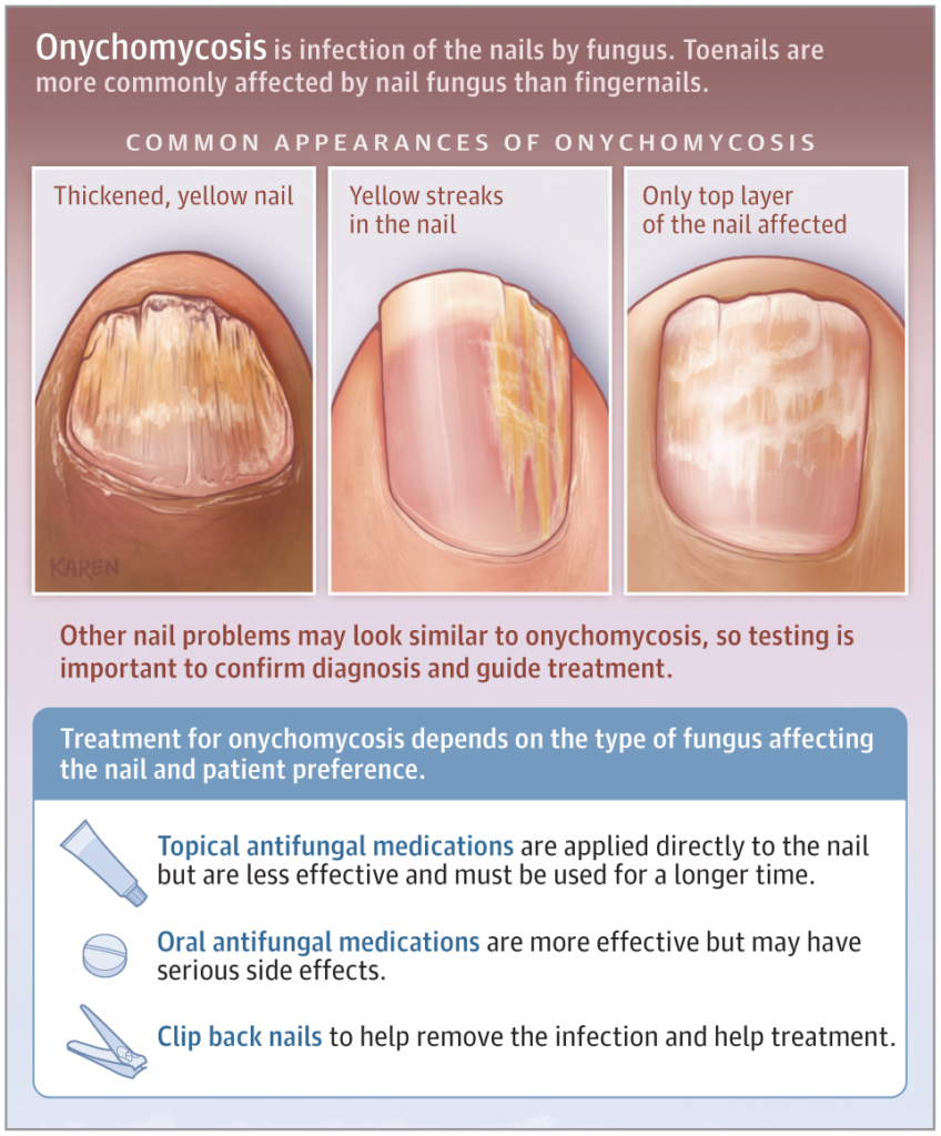 Overcoming Onychomycosis Nail Fungus